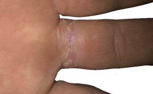 Rash on finger from wearing non-hypoallergenic silicone ring